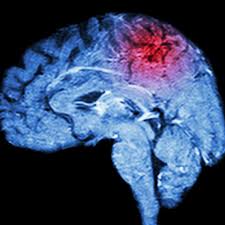 درمان از دست دادن گفتار بعد از سکته مغزی در کرج